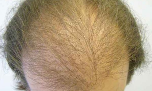 Before and After Hair Transplant Repair Case