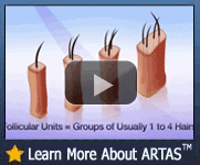 Learn More About The ARTAS Robotic Hair Transplantation