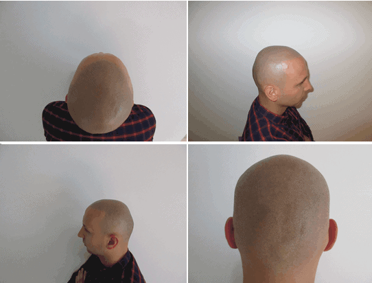 Scalp micropigmentation (tattoo) | Hair Transplantation Toronto | Best Hair  Restoration Toronto