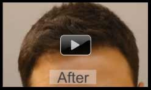 2000 FUE Hairline Hair Transplant