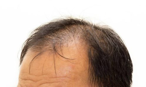 Candidate for Hair Transplant