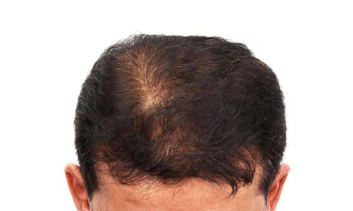 Important Factors in Choosing the Donor Site for a Hair Transplant