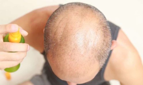 faster hair growth post operation