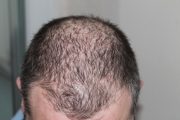 The Classification of Hair Loss