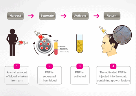 PRP Platelet Rich Plasma Hair Loss Therapy Cycle Illustration