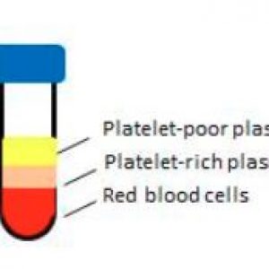 Platelet-Rich Plasma (PRP) for Hair Loss