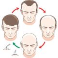 The Benefits and Limitations of Combining Hair Transplant Harvesting Techniques