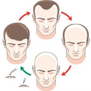 The Benefits and Limitations of Combining Hair Transplant Harvesting Techniques