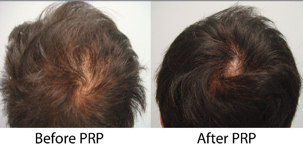 PRP Before and After Crown