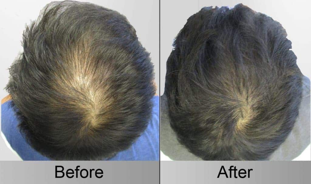 PRP Hair Regrowth Before and After Crown