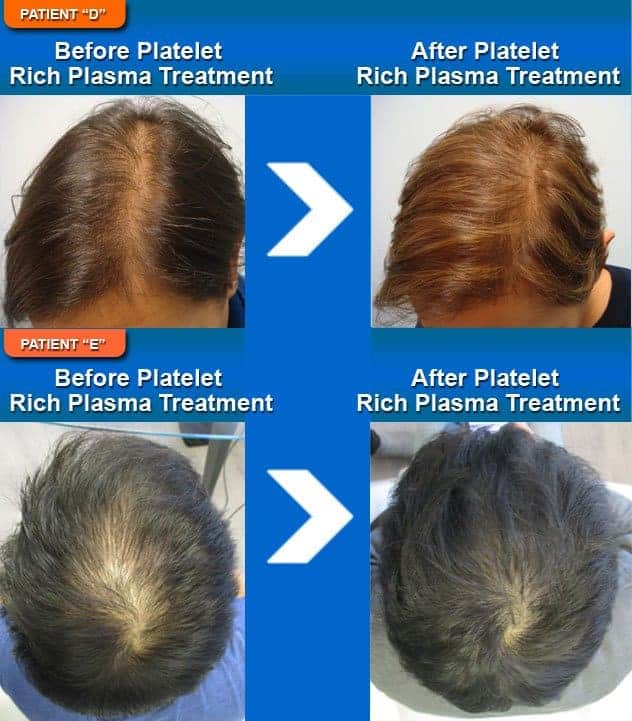Platelet rich plasma before and after pictures
