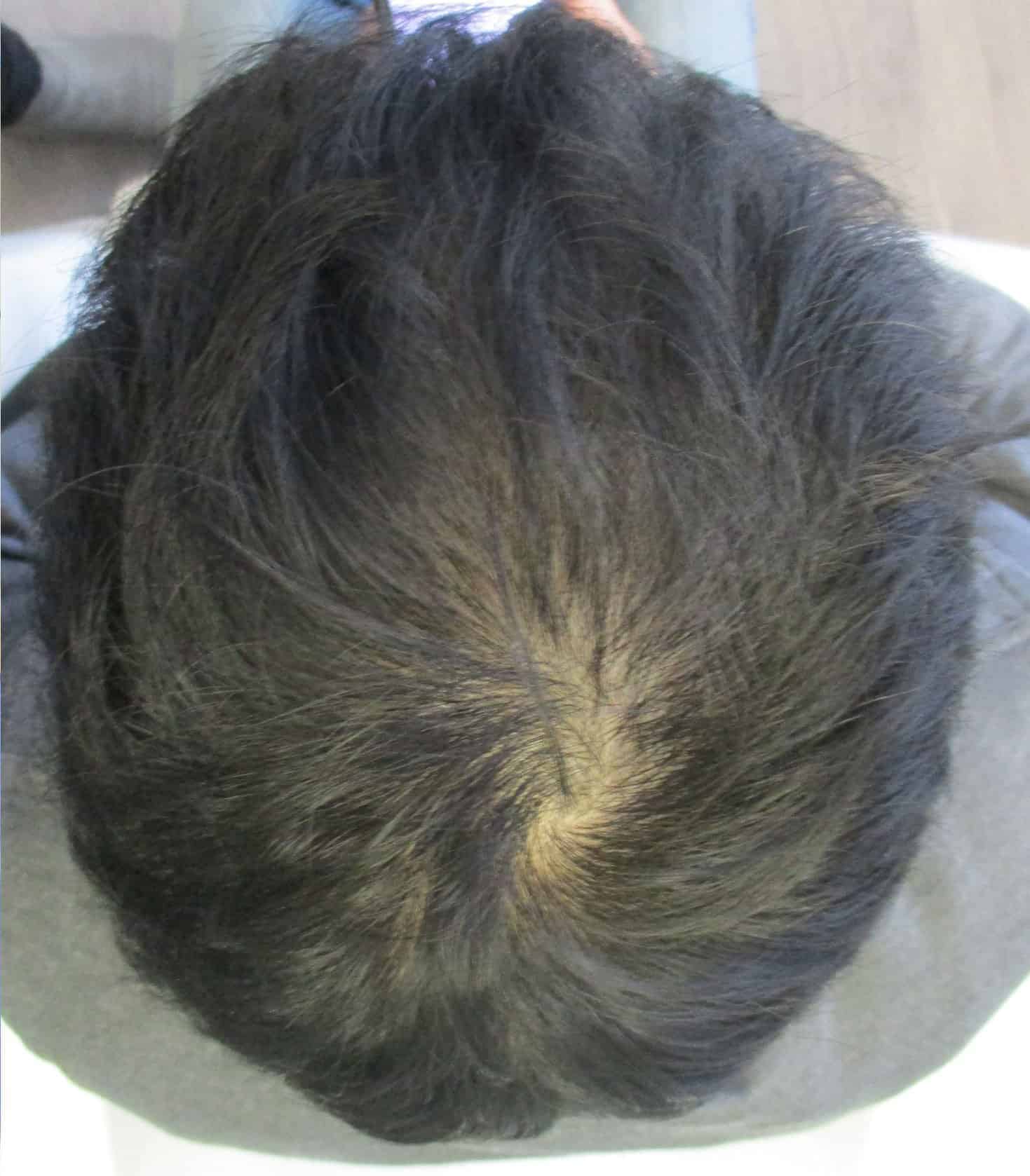 PRP Hair Regrowth After Crown