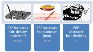 How PRP Works on Androgenic Alopecia