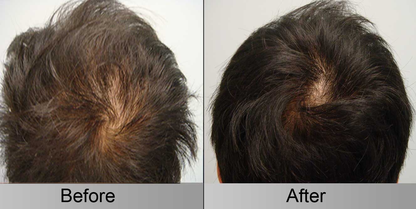 PRP Before & After 2 Client F