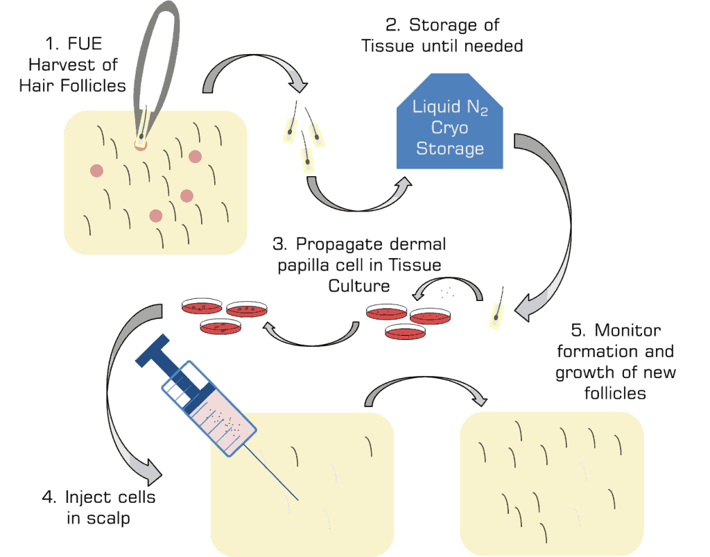 Hair Cloning Update Sure Hair International Hair Restoration Toronto