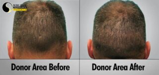 FUE Donor area before and after