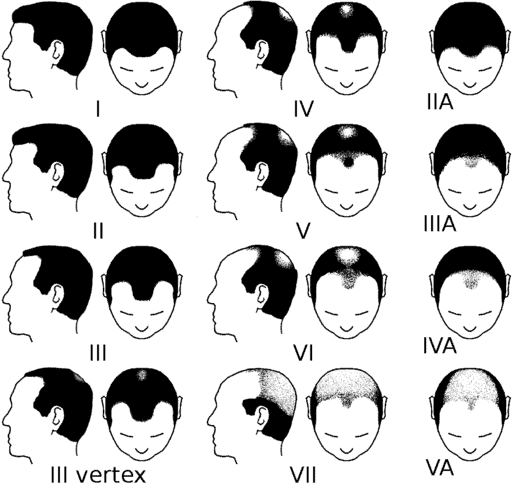 Norwood Scale For Male Pattern Baldness
