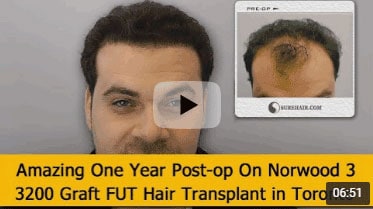 One Year Post-op on Norwood 3 pattern after 3200 Graft FUT Hair Transplant