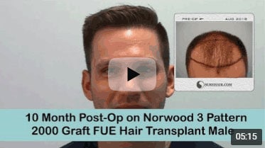 10 Month Post-op on Norwood 3 pattern after 2000 Graft FUE Hair Transplant