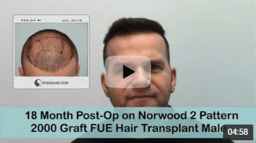 18 Month Post-op on Norwood 2 pattern after 2000 Graft FUE Hair Transplant