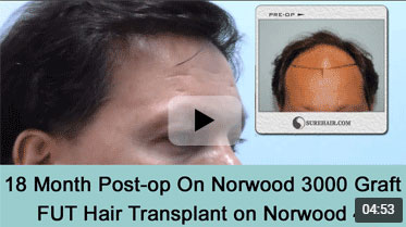 18 Month Post-op on Norwood 3 pattern after 3000 Graft FUT Hair Transplant