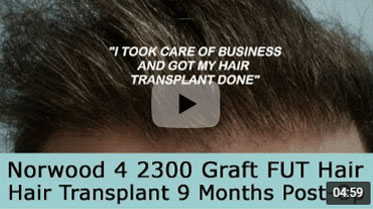 9 Month Post-op on Norwood 4 pattern after 2300 Graft FUT Hair Transplant