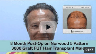 8 Month Post-op on Norwood 5 pattern after 1st 3000 Graft FUT Hair Transplant