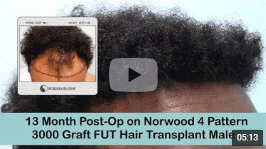13 Month Post-op on Norwood 4 pattern after 3000 Graft FUT Hair Transplant