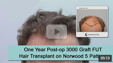 One Year Post-op on Norwood 5 pattern after 3000 Graft FUT Hair Transplant