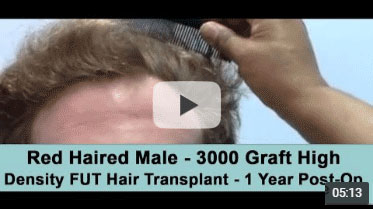 One Year Post-op on Norwood 3 pattern after 3000 Graft FUT Hair Transplant
