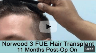 Sure Hair International | FUT & FUE Hair Transplant Toronto