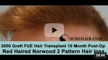 10 Month Post-op on Norwood 2 pattern after 2000 Graft FUE Hair Transplant