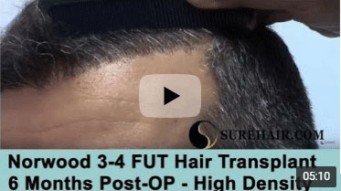 6 Month Post-op on Norwood 3-4 pattern after 2000 Graft FUE Hair Transplant