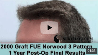 1 Year Post-op on Norwood 3 pattern after 2000 Graft FUE Hair Transplant