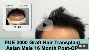 Asian Male 16 Month Post-op on Norwood 3 pattern after 2000 Graft FUE Hair Transplant