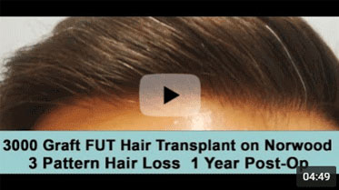 One Year Post-op on Norwood 3 pattern after 3000 Graft FUT Hair Transplant