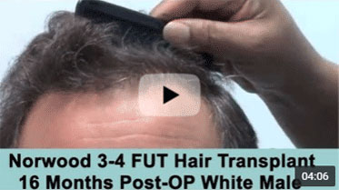 16 Month Post-op on Norwood 3-4 pattern after 3500 Graft FUT Hair Transplant