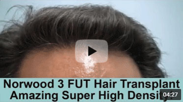 6 Month Post-op on Norwood 3 pattern after 3000 Graft FUT Super High Density Hair Transplant