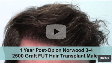 1 Year Post-op on Norwood 3-4 pattern grey hair after 2500 Graft FUT Hair Transplant