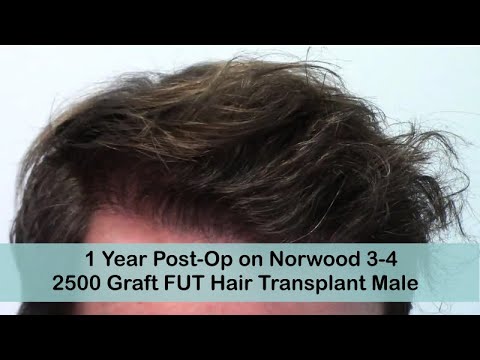 FUT 1 Year Post-Op Norwood 3-4 with 2500 Grafts
