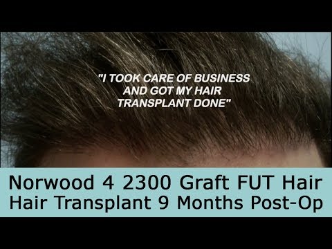 9 Month Post-Op 2300 Graft FUT Hair Transplant on Norwood 4 Pattern