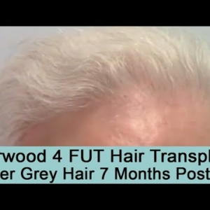 7 Months Post-Op FUT Strip Hair Transplant on Silver Grey haired Patient