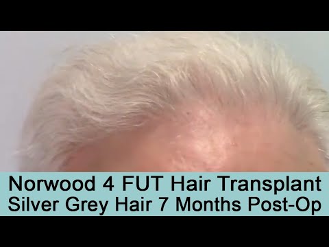 7 Months Post-Op FUT Strip Hair Transplant on Silver Grey haired Patient