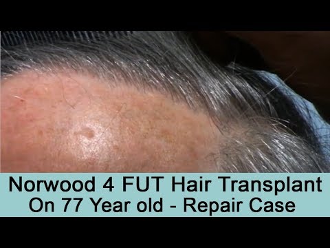 77 Year Old FUT 2000 Graft Hair Transplant Repair Case