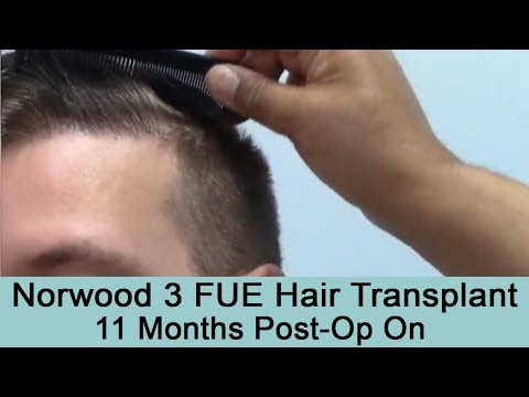 11 Month Post-Op 2000 Graft FUE Hair Transplant on Norwood 3 Pattern