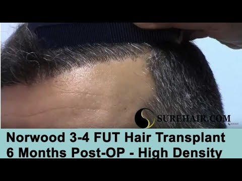 FUE Hair Transplant 6 Months Post-Op On Norwood 3-4 Hair Loss Pattern