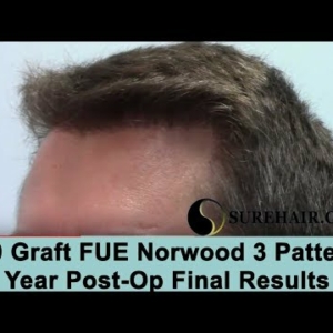 2000 Graft FUE 1 Year Post-Op on Norwood 3 Pattern