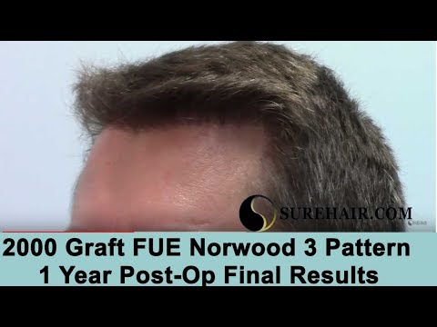 2000 Graft FUE 1 Year Post-Op on Norwood 3 Pattern
