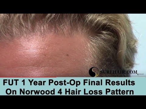 FUT 1 Year Post-Op Final Results Norwood 4 Pattern
