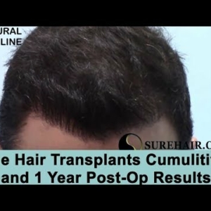Norwood 3 and Crown Hair Transplant Results From 2 FUE Hair Transplant